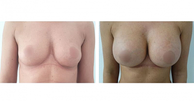 powiększenie piersi klinika chirurgii plastycznej