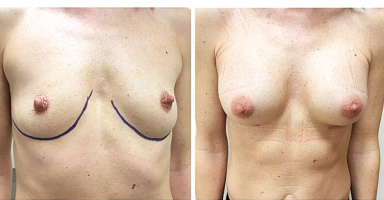 chirurgia plastyczna piersi dr nawrocki