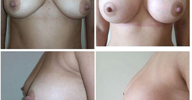 operacje powiększenia piersi