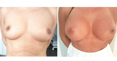 powiększenie piersi chirurgia plastyczna dr ryszard nawrocki